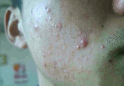 除螨虫，螨虫图