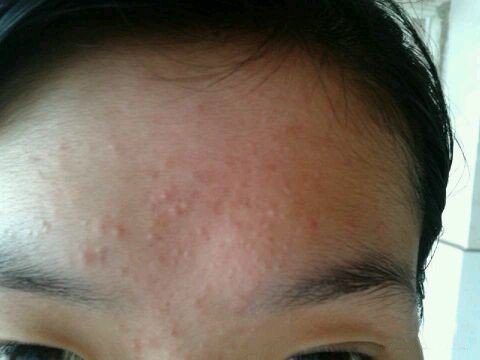 除螨虫，螨虫图